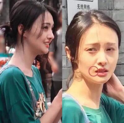 郑爽的嘴怎么烫伤的